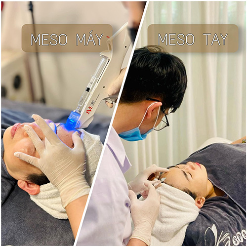 MESOTHERAPY - cấy bằng máy hay bằng tay tốt hơn?